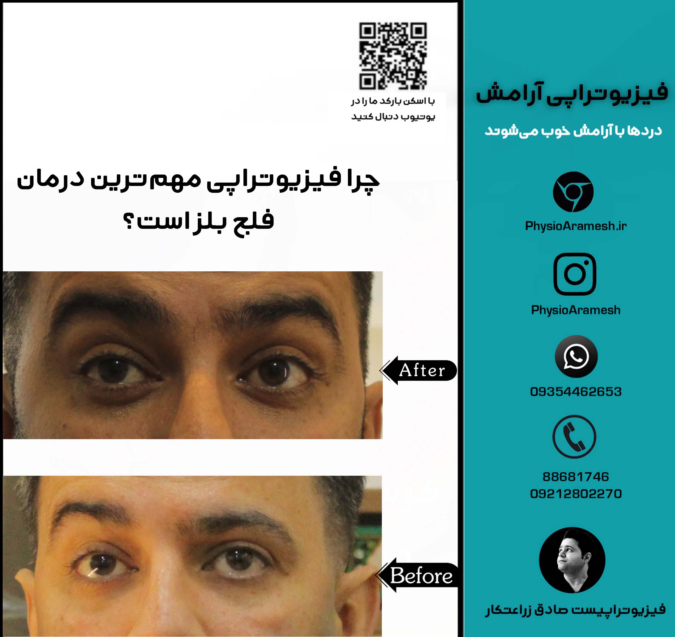 چرا فیزیوتراپی مهم‌ترین درمان فلج بلز است؟